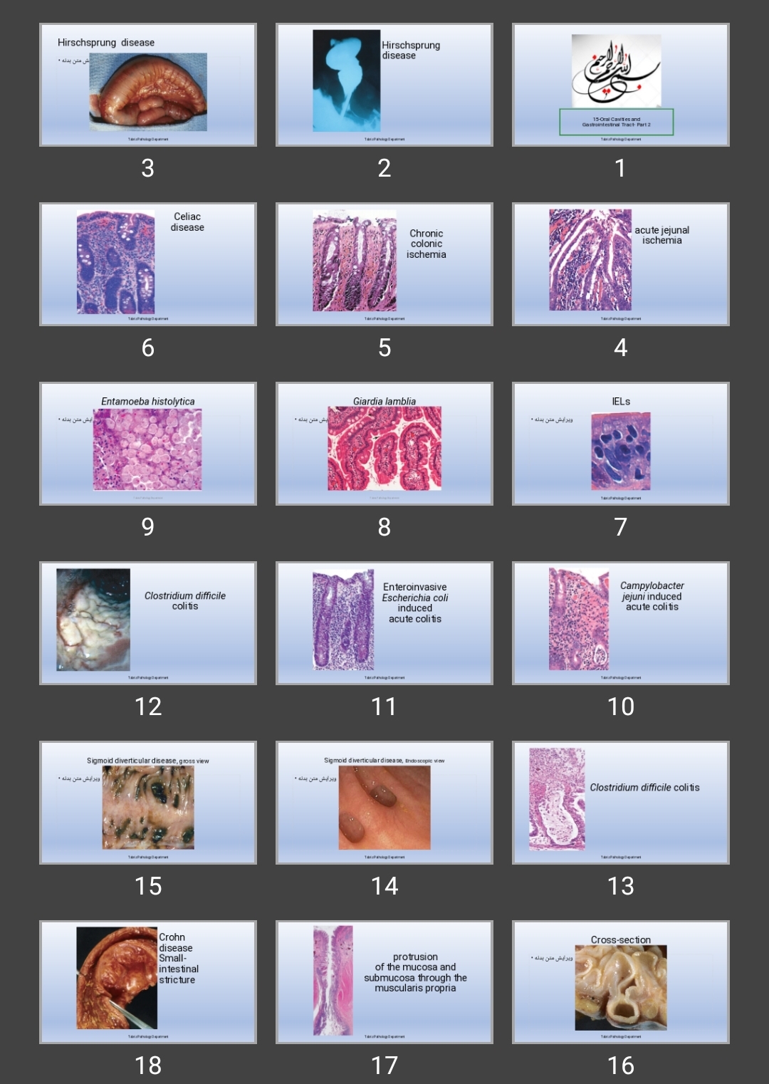 پاورپوینت درس پاتولوژی دهان و دستگاه گوارش Hirschsprung disease