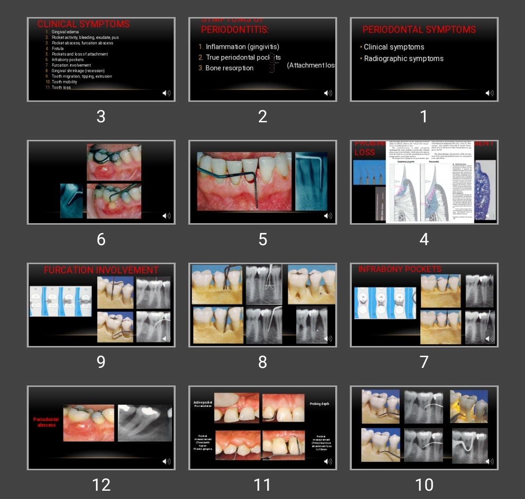 پاورپوینت علائم و نشانه های بیماری های پریودنتال Periodontal symptoms